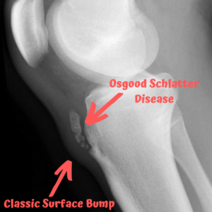Radiography image osgood schlatter disease xray