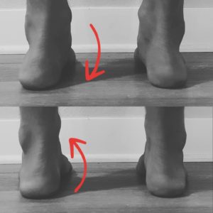 Split image showing re-orientation of collapsed arch with achilles tendonitis