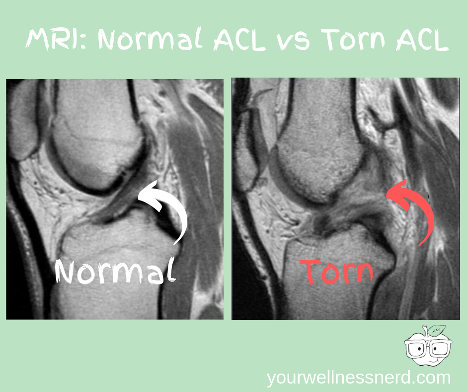 MRI of normal acl and acl injury