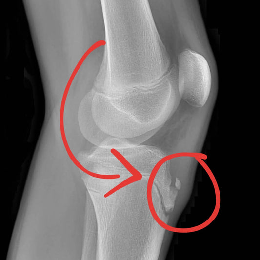 osgood schlatter disease xray