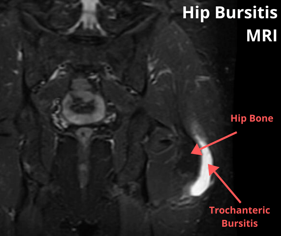 hip bursitis mri or trochanteric bursitis mri